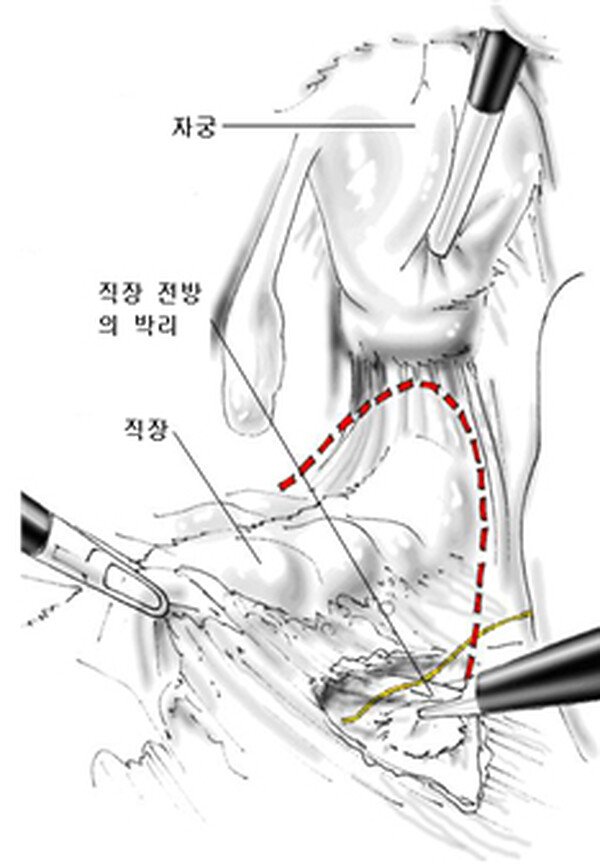 복강경 직장고정술 — 직장 전방을 박리하는 도해