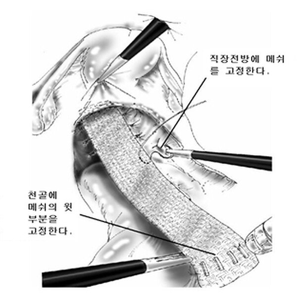 복강경 직장고정술 — 하부직장과 질 사이에 메쉬를 고정하는 도해