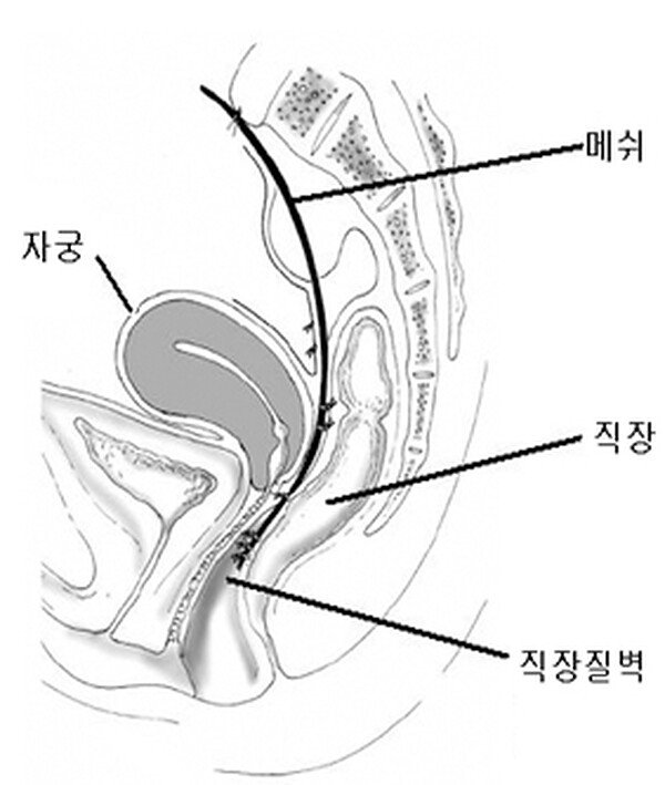 메쉬가 직장질벽을 보강하는 도해