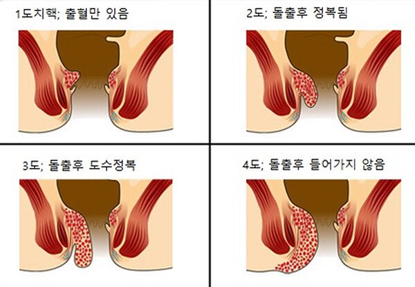내치핵의 진행 정도에 따른 1도·2도·3도·4도 분류