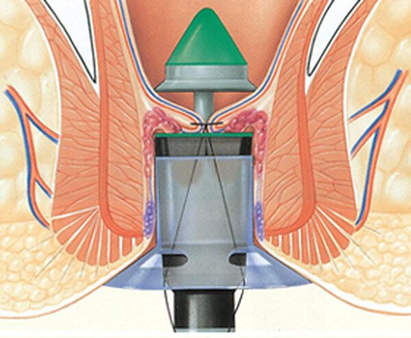 PPH 수술 2단계 — PPH 기구를 넣어 탈항된 치핵조직을 처치