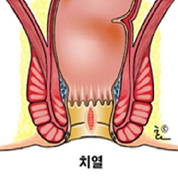 치열 — 항문의 피부나 점막이 찢어진 상태를 나타낸 도해