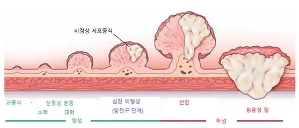 대장 용종 — 대장 점막에서 자라 장 안쪽으로 돌출된 병변 도해