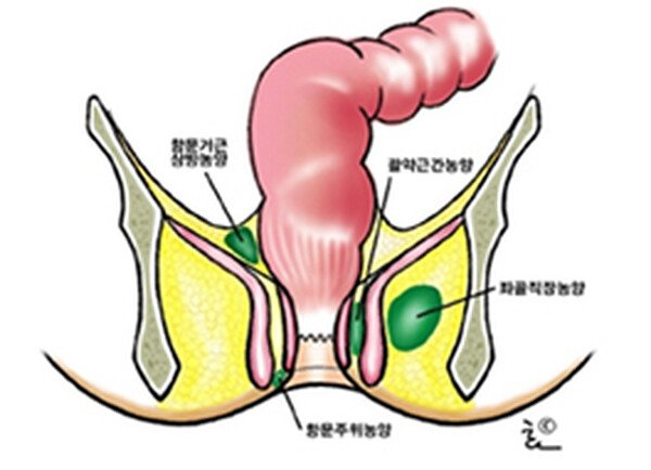 항문 주위 농양의 위치 — 항문선에서 시작되는 염증성 주머니 도해