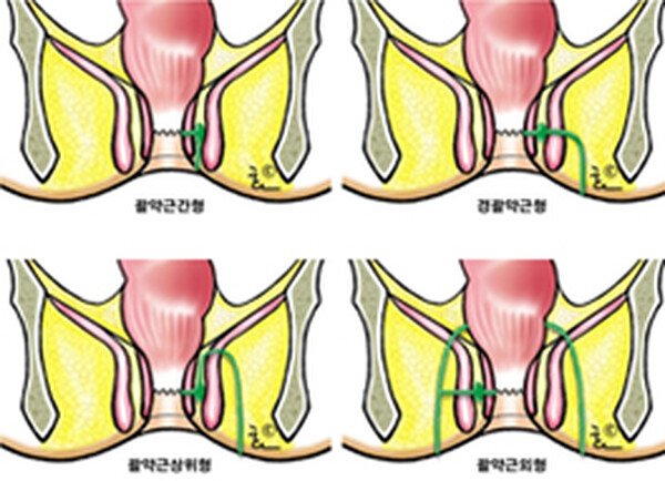 치루 — 항문선과 바깥쪽 피부를 잇는 터널의 유형 도해