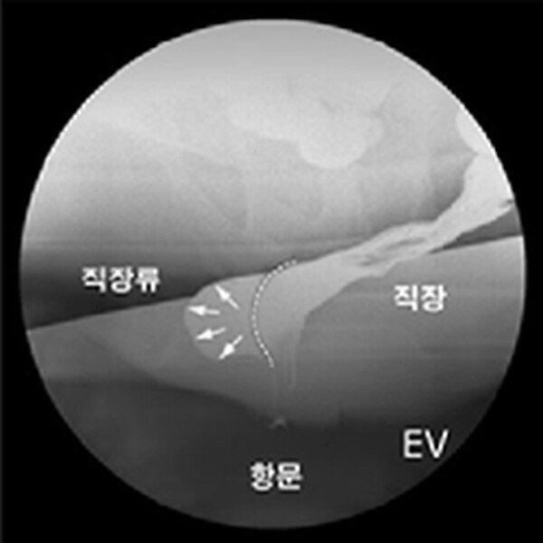 배변조영술 영상 — 직장, 항문과 질 쪽으로 돌출된 직장류