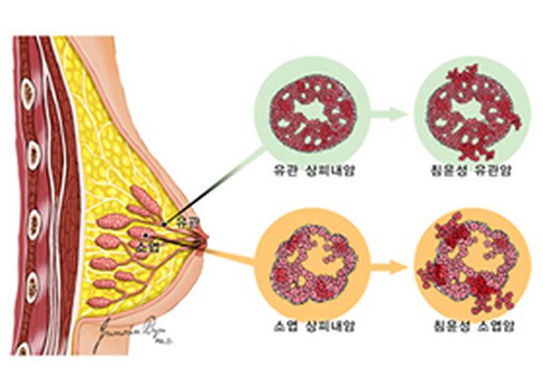 관상피내암과 침윤성 유관암의 차이 — 암세포가 유관을 뚫는 과정