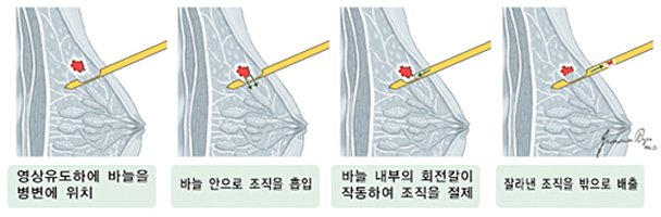 유방 자가검진 촉진 방법 도해